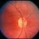 Congenital Nyctalopia